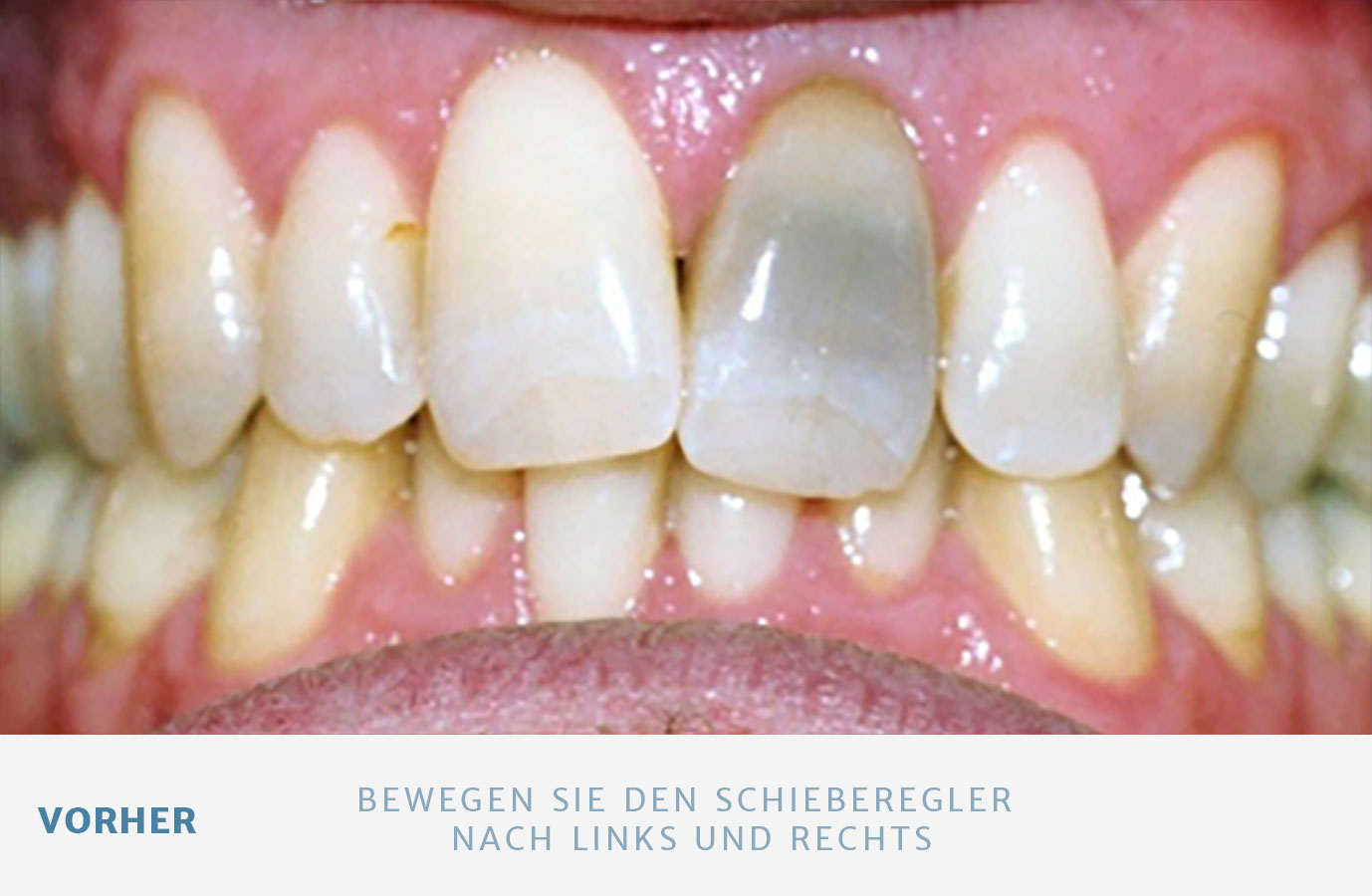 Bleaching Zahnarztpraxistal13 München