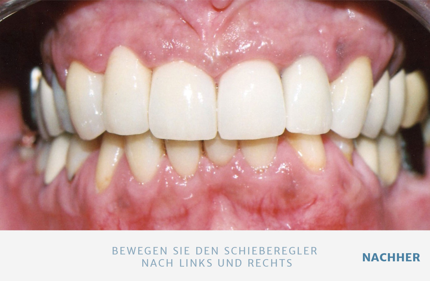 Zahnersatz Zahnarztpraxistal13 München